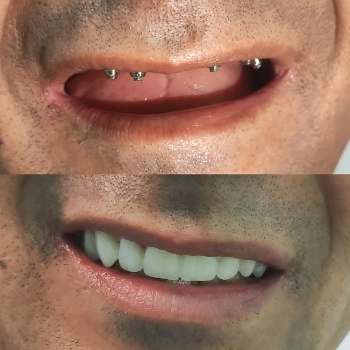 implantes-1.jpg
